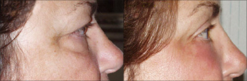 Side-view brow lift patient - 
	The patient came to us concerned that with time, her eyebrows and eyelids had began to sag and that the signs of aging were increasing. After a consultation with Dr. Berkowitz, it was determined that a brow lift would help those problem areas by lifting the entire brow, allowing for a smoother forehead and less pressure on the eye area. The result was the elimination of sagging eyelids, less puffiness under her eyes, and smooth brow.
