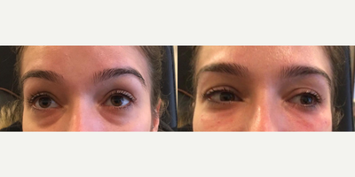 Restylane - Under Eye Tear Trough Correction Using Restylane Refyne at Great Neck Medical Spa