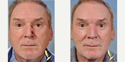 Man treated with Mohs Surgery - Man treated with Mohs Surgery