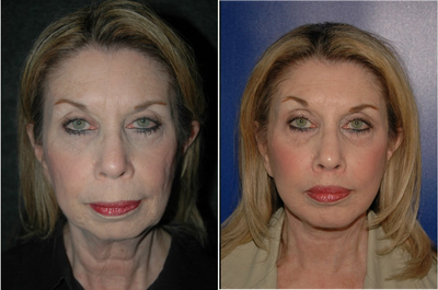Lip Repositioning - Lip Lift + Chin Implant + Deep Plane Facelift