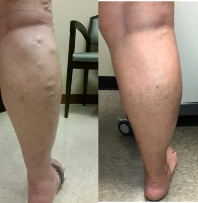 55-64 year old woman treated with EVLT - Our patient underwent EVLT of her Great Saphenous vein about 8 weeks ago and came back in today for her follow up. At this point more than 90% of her veins have resolved and her leg no longer hurts and aches throughout the day.&nbsp;