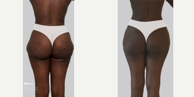Woman treated with Brazilian Butt Lift Revision - Woman treated with Brazilian Butt Lift Revision as well as Liposculpture. Pre-op, she was uncomfortable with the shelf and volume of her buttock. Her hips ended up pointy and didnt go along with her frame.