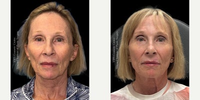 65-74 year old woman treated with CoolPeel, Morpheus8 Microneedling RF & Sculptra - This 65+ year old patient wanted facial rejuvenation without surgery. She had Morpheus8 RF microneedling to firm and smooth her skin, CO CoolPeel Laser treatment to brighten her complexion and soften fine lines, and Sculptra injections to restore midface volume. Her results show lifted cheeks, smoother texture, and a refreshed, more youthful appearance.