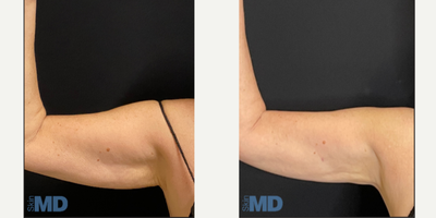 45-54 year old woman treated with Skin Tightening - BodyTite, Skin Tightening of the abdomen and arms.