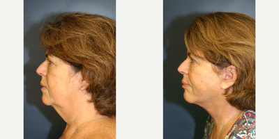 55-64 year old woman treated with Facelift (The Angle Lift) - 60 year old woman treated with a facelift (The Angle Lift)