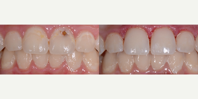 18-24 year old woman treated with Tooth Repair - These cavities were discovered with great disappointment after her braces were removed.