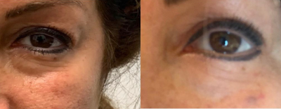 45-54 year old woman treated with Secret RF - Before and after two secret Rf treatments to fill under eye hollows naturally.