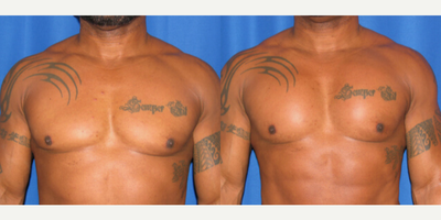 Man treated with Pec Implants - Man treated with Pec Implants