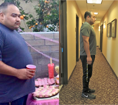 25-34 Year Old Man Lost 74 lbs In Just 9 months With The Lap Band Procedure - 25-34 Year Old Man Lost 74 lbs In Just 9 months With The Lap Band Procedure