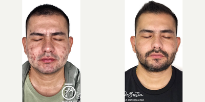 Man treated with Skin Rejuvenation - The patient presented with active acne and its consequences, as are the scars.In this case, we use a combination of technologies to treat both active acne and improve the aftermath of acne.