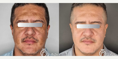 Man treated with Skin Rejuvenation - Melasma Treatment There are various and varied treatments for Melasma, but you must know that before performing any procedure, the most important thing is to prepare the skin.Did you know that various pigmentary disorders can recur (reappear) with carrying out a procedure due to what I mentioned before (lack of skin preparation)? !! 
