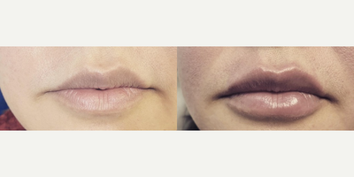 Woman treated with Restylane Silk - Woman treated with Restylane Silk