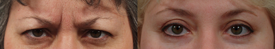 51 year old woman treated with Botox - Patient had botox placed in glabella 6 weeks after receiving an upper and lower lid blepharoplasty in the OR