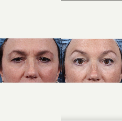 45-54 year old woman treated with Botox - 45-54 year old woman treated with Botox
