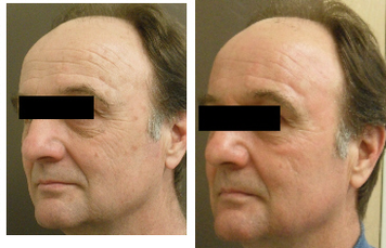 Pixel laser - 57 year old male patient with long history of excessive sun exposure presented with concerns about the photo damage on his face, particularly skin discoloration, moderate to severe wrinkling, and overall wanted to improve the texture of his skin.  Notice his lines are softer, brown spots are completely removed and his skin generally looks softer and more youthful.