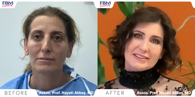 35-44 year old woman treated with Revision Rhinoplasty, Facial Fat Transfer, Eyelid Surgery - 44 years old woman treated with Facial fat transfer, eyelids surgery (Blepharoplasty), and Revision Rhinoplasty surgery. all applied in one operation. After 3 months of the operation.