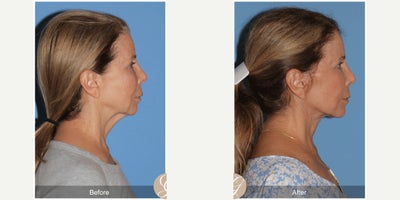 69 year old woman treated with Deep Plane Facelift, Facelift, Neck Lift, Dermal Fillers, MACS Facelift - 69 year old woman treated with Deep Plane Face and Neck Lift, Filler to the Temples and Chin, Laser to Face MAC