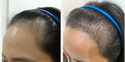 25-34 year old woman treated with DHI Hair Transplant, FUE Hair Transplant, Hair Transplant - A middle-aged Asian woman came in for a FUE hair transplant to lower her frontal hairline using 1,500 grafts. She hasn't been taking any medications for the hair loss.