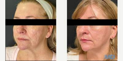 45-54 year old woman treated with NeoGen Plasma - This lovely patient received 1 NeoGen low energy treatment. She is please with the improved texture and tone of her skin. Reduced pigmentation is also to be noted!