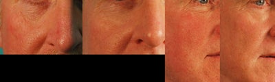 Male treated for Redness and Pore Size - Laser Genesis to treat redness and overall texture of the skin