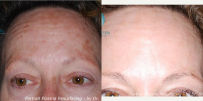 55-64 year old woman treated with Portrait - Before and after results of Portrait Plasma Resurfacing