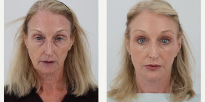 65-74 year old woman treated with Facelift, Neck Lift, Brow Lift, Eyelid Surgery, Facial Fat Transfer, Chemical Peel - 66 year old 2.5 months post Facelift, Neck lift, Brow Lift, Lower Bleph, Fat transfer and TCA peel