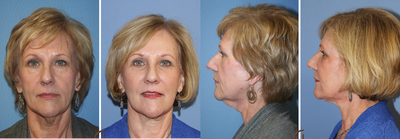 Natural Looking Lower Face Lift with Fat Grafting  - This patient had a lower face and neck lift with Dr. Kevin Sadati. &nbsp;In addition to this surgery she had Fat Grafting to the face with PRP (Platelet Rich Plasma). Everything was done in office under local anesthesia with the use of oral sedation, there was no need for general anesthesia. &nbsp;The patient has since then returned to Dr. Kevin Sadati for minimally invasive procedures such as Botox. &nbsp;