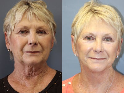 LiteLift, Platysmaplasty and Lower Pinch Blepharoplasty on 70-year-old Women - 
	This 70-year-old woman looks delighted after having the LiteLift, a Platysmaplasty and a Lower Pinch Blepharoplasty. Notice in the post-op photos, her jaw line appears better defined. Also, her neck appears to have more smooth and refined skin post-op. A pinch of lower lid has resulted in a refreshed appearance.&nbsp;

