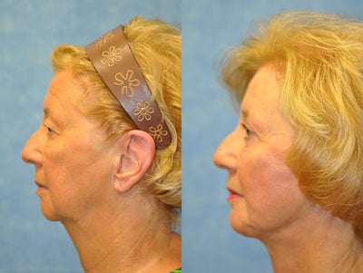 70 Year Old Female Treated for Unacceptable Cosmetic Appearance of Face - 
	Procedure: Chin Implant
