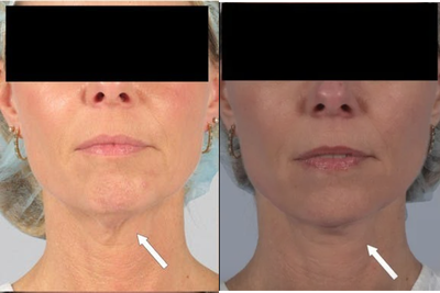 Platysmaplasty for neck muscle bands - A platysmaplasty was performed with lower face lift to tighten central neck bands caused by muscle laxity with aging.
