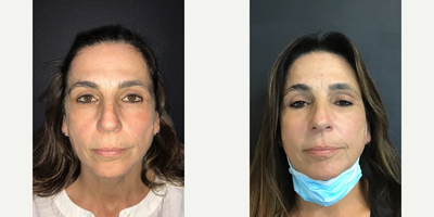 Woman treated with Laser Resurfacing - Woman treated with Laser Resurfacing- 4 months post-op