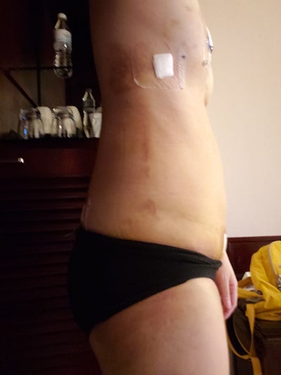Saline Implant Removal + Belly Fat to Breast AAA Cup - Review 
