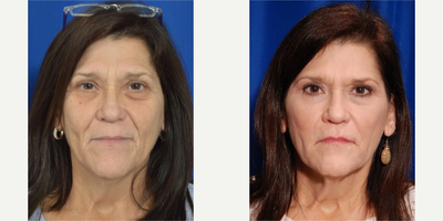 45-54 year old woman treated with Liquid Facelift - This patient was looking for alternatives to surgery for a low downtime facial rejuvenation.  Treatment was with Juvederm Ultra and Juvederm Voluma