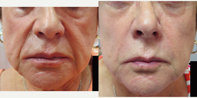55-64 year old woman treated with Vampire Facelift - Vampire Facelift performed with 3 syringes of Bellafill and PRP injection.
