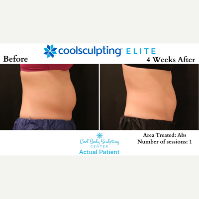 25-34 year old woman treated with CoolSculpting Elite - CoolSculpting before and after in Virginia Beach
