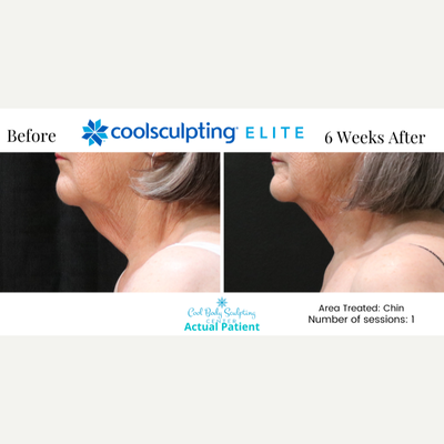 65-74 year old woman treated with CoolSculpting Elite - CoolSculpting results on Chin