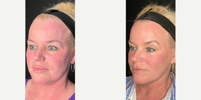 35-44 year old woman treated with Opus Plasma - This client had one Opus Plasma treatment and Exosomes. Her main concerns were tone and skin laxity.
