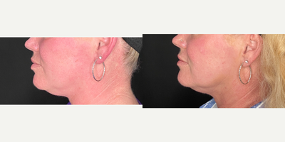 35-44 year old woman treated with Opus Plasma - This client had one Opus Plasma treatment and Exosomes. Her main concerns were tone and skin laxity.