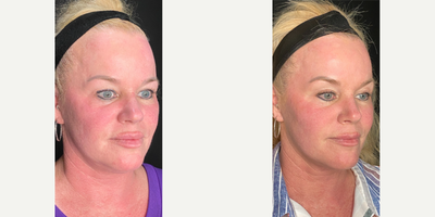 35-44 year old woman treated with Opus Plasma - This client had one Opus Plasma treatment and Exosomes. Her main concerns were tone and skin laxity.