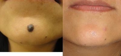 Cosmetic Mole Removal - Cosmetic mole removal