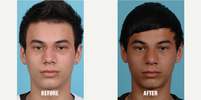 18-24 year old man treated with Rhinoplasty - This patient presented after a devastating injury where he lost most of the cartilage in his septum. He complained of severe breathing difficulties through both his nostrils with the inability to breathe from either side of his nose. He also was very concerned from the collapsed appearance of his nose. He was found to have lost most of his cartilage from his septum from a complication stemming from his injury. A small strip of cartilage from his rib was used to reconstruct his nose and correct his breathing problem.