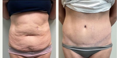 Woman treated with Panniculectomy - Woman treated with Panniculectomy by Dr. Bonett at Naples Plastic Surgery.
