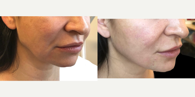 35-44 year old woman treated with Silhouette Soft - The before and after photos above are just an example of lips enhancement treatment. The results vary from one patient to another and there is no guarantee that all patients, who will have the procedure will have similar results.