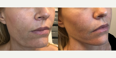 45-54 year old woman treated with Silhouette Soft - The before and after photos above are just an example of lips enhancement treatment. The results vary from one patient to another and there is no guarantee that all patients, who will have the procedure will have similar results.