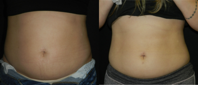 25-34 year old woman treated with Emsculpt - Female patient, age 30, 6 weekly sessions of EmSculpt Neo