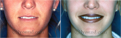 Lip Augmentation - 
	25-year-old woman before and after lip augmentation with Alloderm and fat injection.
