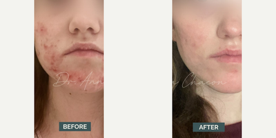 Woman treated with Accutane - Woman treated with Accutane