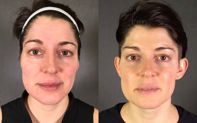35-44 year old woman treated with Secret RF - 36 year old female who has had 3 treatments of Secret RF Microneedling with PRP.