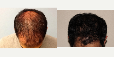 25-34 year old man treated with Hair Loss Treatment - This patient received ALMI scalp treatments followed by six PRP sessions to the scalp over the course of eight months.