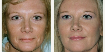 Woman treated with Sculptra Aesthetic - Woman treated with Sculptra Aesthetic